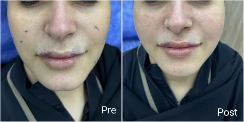 Beautification of the face and cheeks